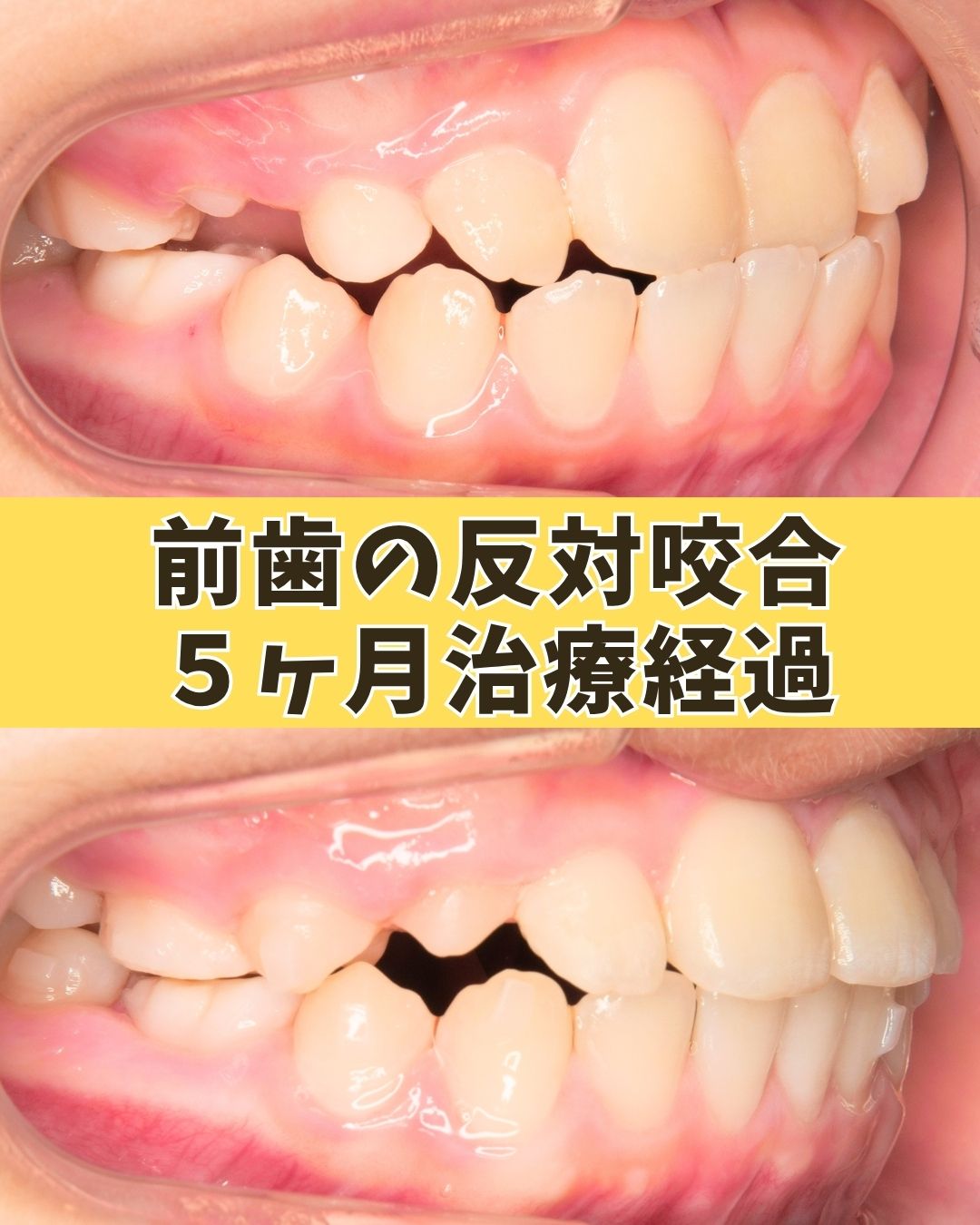 小学校高学年(治療経過)｜反対咬合と受け口が気になっていたケース