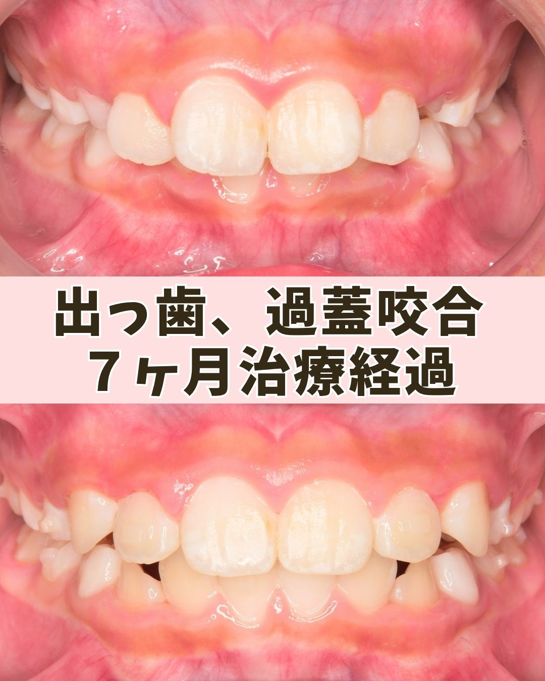 ９歳（治療経過）｜出っ歯が気になり、深い噛み合わせとガタつきがあるケース